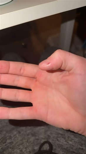What happens if a box cutter closes on your thumb