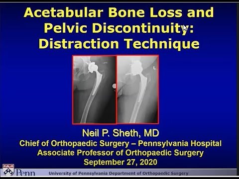 Acetabular Bone Loss in Hip Arthroplasty- The Distraction technique