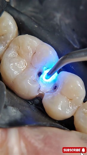 Dark Pit Invasion – Deep occlusal decay spreading into dentin #dentaltransformation #dentist