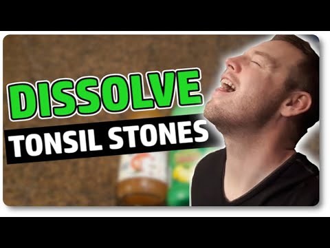 Dissolve Tonsil Stones At Home With Only 3 Ingredients