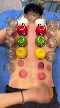 The feeling after cupping therapy is amazing.