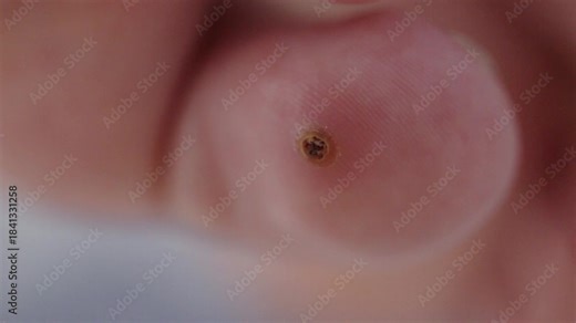 Macro view of plantar wart situated on sole of human foot, specifically on one toe. Lesion displays characteristic dark center and rough texture, indicating viral infection.