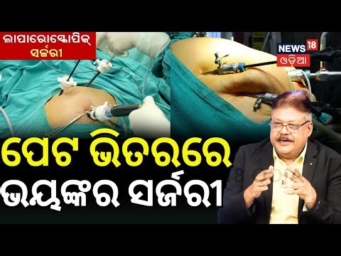 ପେଟ ଭିତରେ ଭୟଙ୍କର ସର୍ଜରୀ | Laparoscopic Gallbladder Removal: What to Expect, Procedure, and Recovery