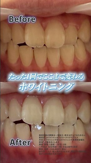 歯医者のホワイトニングは効果ある？1回でどこまで白くなるのか解説
