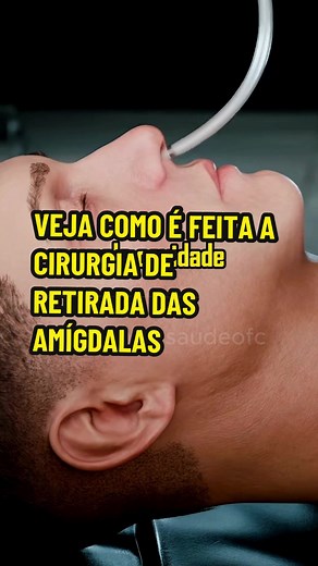 Como é feita a cirurgia de retirada das amígdalas #saude #saudavel #curiosidades #garganta #amigdalas