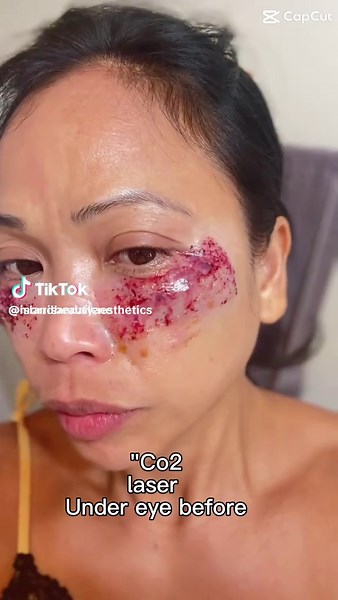 Revitalize Your Skin with CO2 Laser Resurfacing