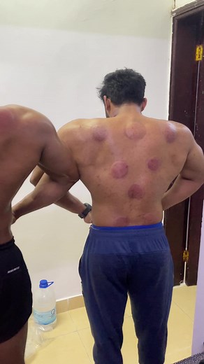 cupping therapy has been around for so many years in Chinese medicine.