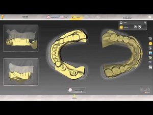 inLab SW 15: Multi-Unit Implant Bridge