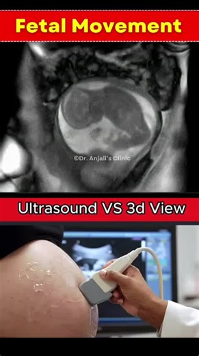 Ultrasound Insights: Baby Kicking in the Womb