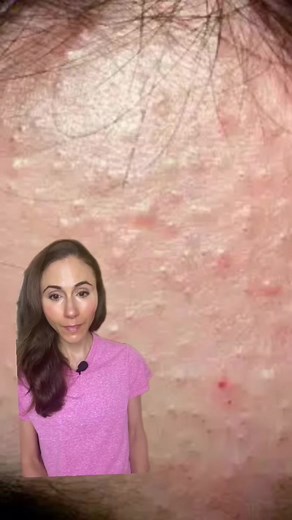 9.5K views · 136 reactions | Bumps on the forehead may be closed comedones (aka whiteheads). These are caused by skin cells that don’t mature correctly & get stuck together. Retinoids, like tretinoin or Adapalene, can improve the way these cells mature, helpibg to clear & prevent comedones. #whitehead #whiteheadremoval #comedones #cloggedpores | Dr Dray | Facebook