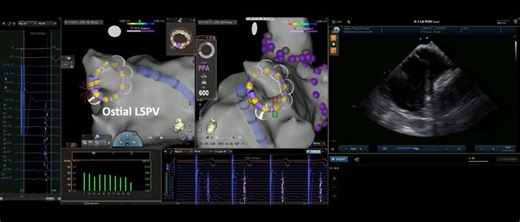 Pulsed field ablation for atrial fibrillation with VARIPULSE #PFA system | Alejandro Jimenez Restrepo posted on the topic | LinkedIn