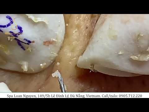 Blackheads are back (232) | Loan Nguyen