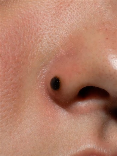 “This cyst kept growing under the skin…” #foryou #oddlysatisfying #asmr #dermatology #fyp