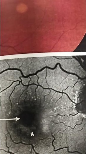 Adult onset macular vitelliform dystrophy