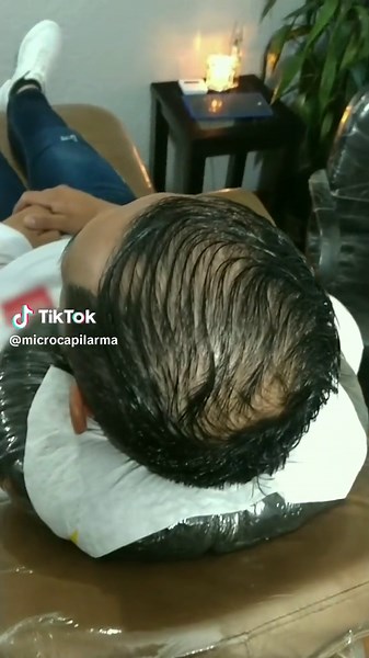 La Micropigmentacion Capilar no es solo para personas con alopecia avanzada, también funciona para personas con baja densidad capilar y que desean cubrir esos espacios claros y generar un efecto de mayor densidad. DEJA TU LIKE Y PIDE TU VALORACIÓN. Deja tu cabeza en manos de un experto. ⚫ pigmento: BLVK LABEL @pigmentos_5pm @5pm_shadow_pigments 🎯 Cartucho: @wjx_colombia 🖋️ Maquina: Portex P2S de @eztattooing 🛑Grip: @neogrips ❇️ Aftercare: @balm_tattoo #microcapilarma#micropigmentacioncapilar 