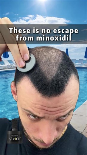 Hair_xinxin on Instagram: "（Worried About Harsh Chemicals on Your Scalp?） Why compromise safety for beauty? Our gentle hairline powder is vegan-friendly and free from irritants, designed for all hair types! It nourishes with keratin while camouflaging thin spots. Plus, low minimums let you test it risk-free. DM us to transform your hair routine today! 🌿 #SafeHairCare #VeganBeauty #ScalpFriendly #HairHealth #LowMOQ #Sevich"