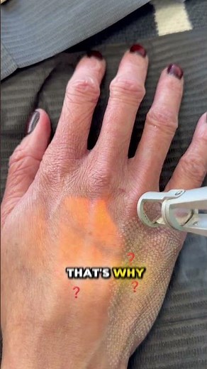 What is Erbium YAG laser resurfacing and why does it look like this? #laser #hands #skintreatment