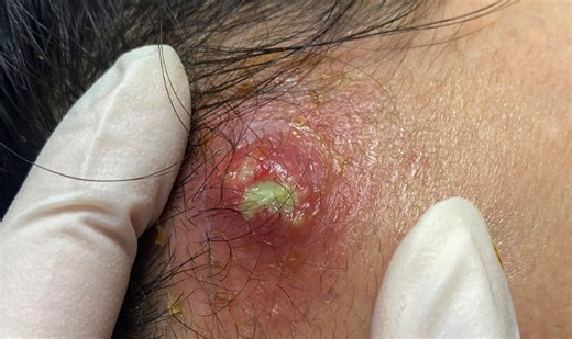 Large Infected Cyst on Forehead Popped