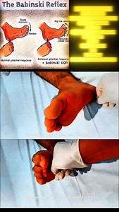 The Toe Tell 👣 The Babinski Sign Stroke the sole, see the toes react. If the big toe points up and others fan out in an adult, it’s called the Babinski sign — and it can signal a nervous system issue like stroke, MS, or spinal injury. In kids under 2, it's normal! The Babinski reflex occurs after the sole has been firmly stroked. The big toe then moves upward or toward the top surface of the foot. The other toes fan out. This reflex is normal in children up to 2 years old. It disappears as the 