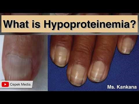 What is Hypoproteinemia
