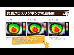 円錐角膜診察のポイント