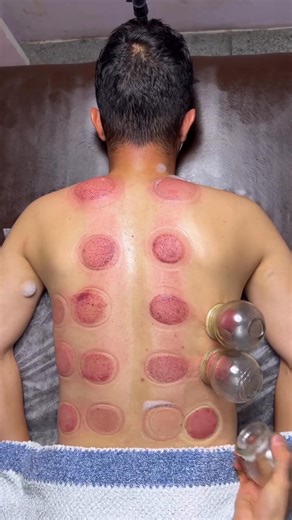 236K views · 1.2K reactions | wow pizza cuping . . . . . . . #cupping #cuppingtherapy #cuppingmassage #asmr #asmrslime #asmrsounds #asmrvideo #massage #india #dubai #viralreels #trendingreels #fyp #fire #pizza #explore | Asmralinezhad | Facebook