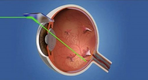 06 Laser Procedure for PDR