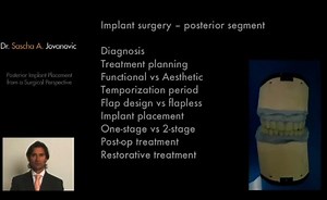 Posterior Implant Placement from a Surgical Perspective