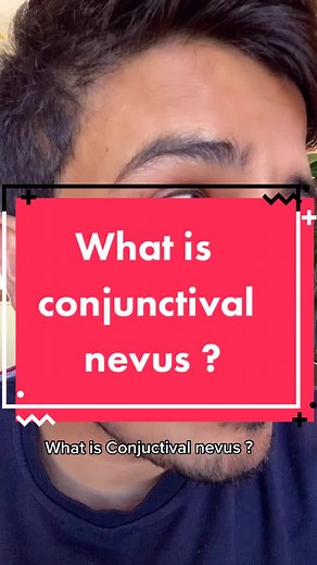 Understanding Conjunctival Nevus in Ophthalmology