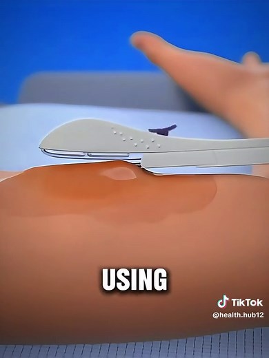 How Nexplanon Implant Insertion Is Done ? (Medical Animation 3D) #nexplanon #nexplanoninserted #nexplanonimplant #nexplanonremoved #nexplanoncheck #medicalanimation