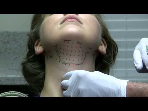 Kybella- lose your double chin without surgery by Dr. Joe Niamtu - Richmond, Virginia