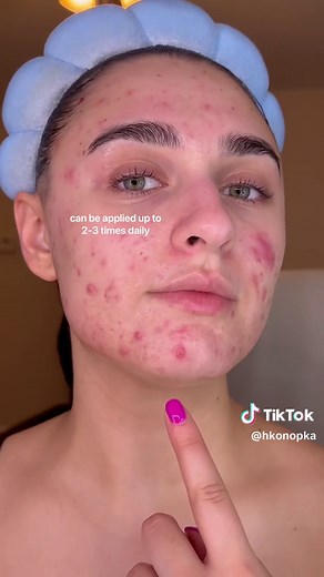 Bubble Acne Spot Treatments: Results & Reviews