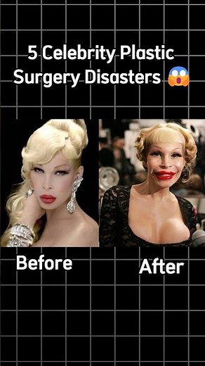 5 Celebrity Plastic Surgery Disasters 😱 #shorts #plasticsurgery