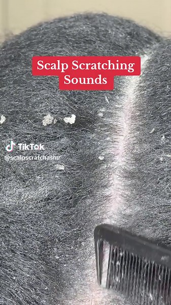 Satisfying Scalp Scratching #scalpscratchasmr #scalpdandruff #dandruff #asmrhairplay #asmrscalpscratching #asmr #seborrheicdermatitis