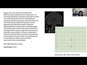 Epilepsy Lecture