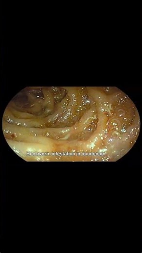 UGI Endoscopy Revealed Multiple Hookworms in Duodenum