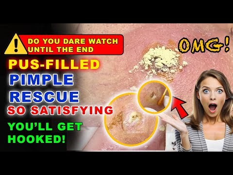 Years-Old Pimples and Abscess Pops – So Satisfying, You Won’t Be Able to Stop Watching!
