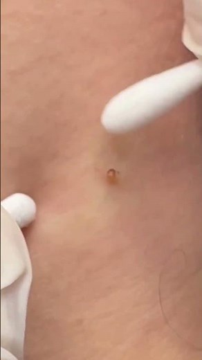 Close-Up Acne Extraction | Simply Dermatology | Dr. Kally Papantoniou