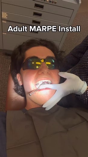 Patty | MARPE on Instagram: "How my #marpe install went, and an update 48 hours later #mse #orthodontics #dentistry #facemask #expansion"