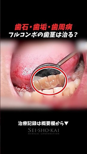 歯石・歯垢・歯周病…フルコンボの限界歯茎治療 #歯医者 #歯周病 #歯石除去