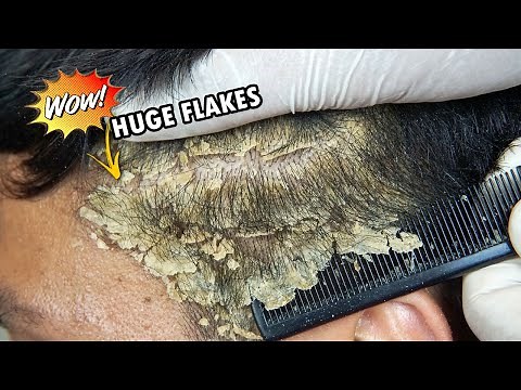 Huge Dandruff Flakes Removing and Picking #635