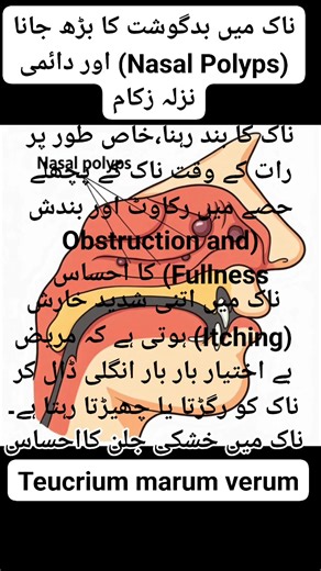 Nasal polyps and Teucrium marum veru #nasalpolyp #homeopathy #homoeopathicmedicine Islamabad Homeopathic Clinic Dr Ata Ur Rehman Shaheen market I-10/1 Islamabad For appointment Whatsapp 03215152749 | Islamabad Homeopathic Clinic Dr Ata Ur Rehman