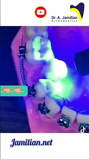 Orthodontic Alignment of a Displaced Premolar: Bringing the Tooth Back into the Arch #orthodontics