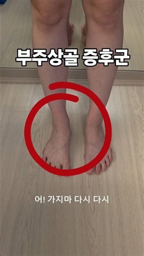부주상골증후군!!!