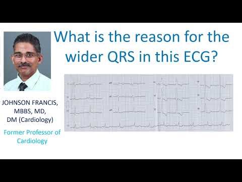 ECG with Wide QRS