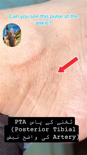 Visible Posterior Tibial Artery (PTA) pulse at the ankle is an important clinical sign of good blood