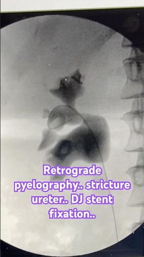 #Retrograde pyelography showed #stricture lumbar #ureter. Difficult DJ stent fixation..