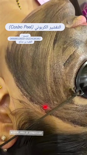 Carbon Peel Treatment by Dermatologist: Benefits & What to Expect