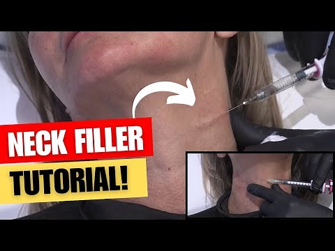 REMOVE NECK LINES WITH FILLER TUTORIAL