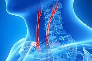 Carotid angioplasty and stenting: what are we talking about?